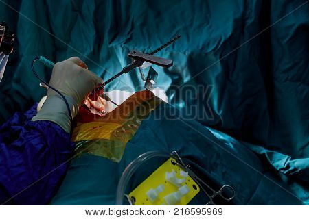 Teamwork Surgeons During Open-heart Surgery