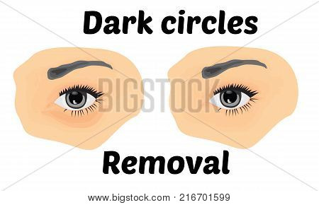 Dark circles under eyes to remove. Vector illustration
