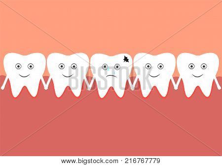 A number of teeth in the oral cavity, one of which is affacted by caries.