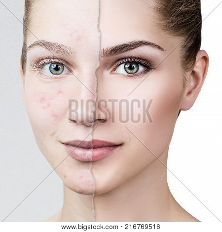 Comparison portrait of old photo with acne and healthy skin of young girl. Skincare concept.