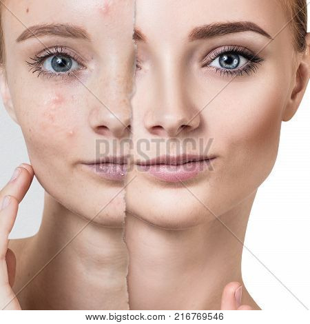 Comparison portrait of old photo with acne and healthy skin of young girl. Skincare concept.