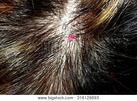 Hemangioma On The Head. Red Mole On The Scalp. Mole In The Hair. Red Birthmark.