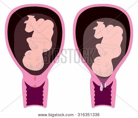 Preterm Labor Baby, Human Body. 3d Illustration Transparent Png Images.