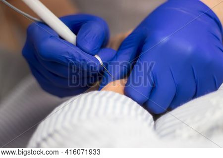 The Doctor's Hands In Sterile Medical Gloves Of Blue Color Make The Procedure Of Removing Papillomas
