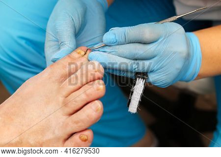 Fungal Disease Of The Toenail. Treatment And Restoration Of Health On The Toenails. The Doctor Podia