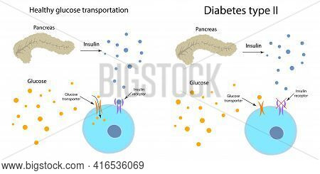 Diabetes Type 2 And Healthy Transportation Comparison. Pancreas, Insulin Receptor, Glucose Transport