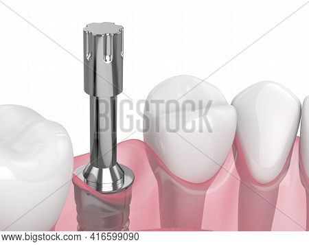 3D Render Of Dental Implant With Multipeg To Check Implant Stability