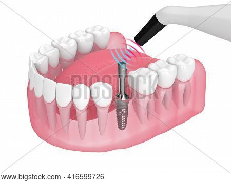 Checking Dental Implant Stability By Osseointegration Monitoring Device