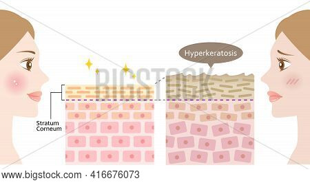 Diagram Of Thickening Of The Stratum Corneum And Woman Face.beauty Treatment  Before After Illustrat