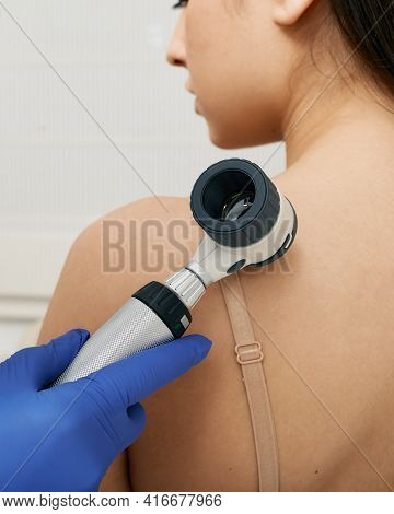 Mole Dermoscopy. Physician Check-up Of A Patients Skin With A Dermatoscopy For Prevention Of Melanom