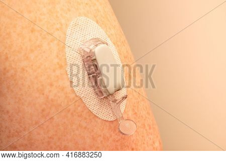 Cgm - Continuous Glucose Monitoring: Sensor Installation On The Upper Arm. Sensor Pod. Transmitter A