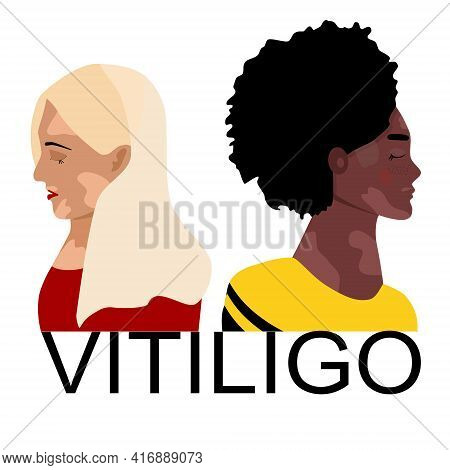 World Vitiligo Day.young Women Different Ethnicities With Skin Disease. Depigmentation Problem. Patc