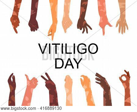 World Vitiligo Day Poster.hands Different Ethnicities In Various Gestures With Skin Disease. Depigme