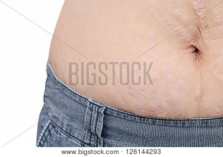 Closeup of stretch mark on woman belly