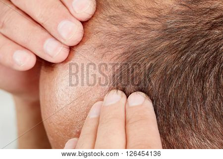Hair loss.
