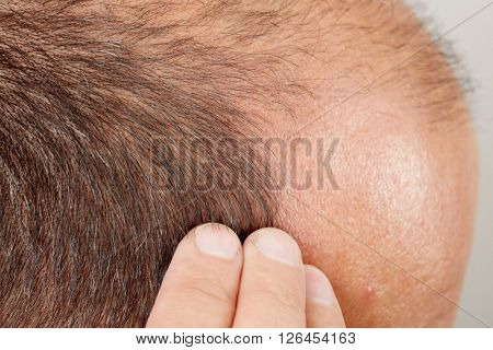 Hair loss.
