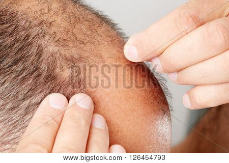 Hair loss.