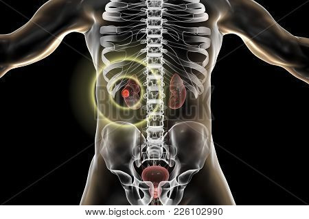 Treatment Of Kidney Cancer, Conceptual Image. 3d Illustration. Kidney Tumour Disease Therapy And Pre