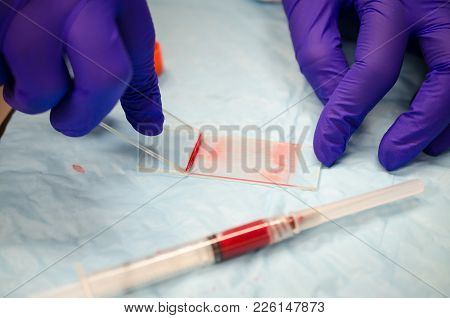 Blood Slide Preparation With A Drop Of Blood For Gross Blood Examination