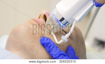 Close-up. Microneedle Rf Lifting Procedure. Hardware Cosmetology. Beautician Conducts A Facial Rejuv