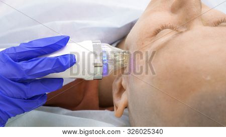 Close-up. Microneedle Rf Lifting Procedure. Hardware Cosmetology. Beautician Conducts A Facial Rejuv