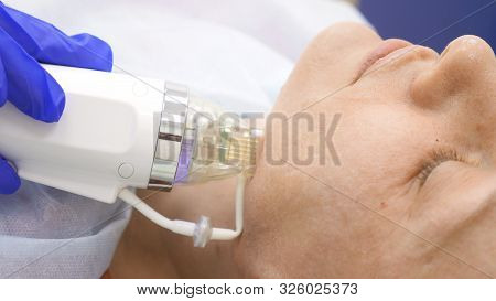 Close-up. Microneedle Rf Lifting Procedure. Hardware Cosmetology. Beautician Conducts A Facial Rejuv