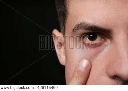 Man Checking His Health Condition On Black Background, Closeup And Space For Text. Yellow Eyes As Sy