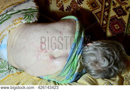 Decubitus Ulcer. Pressure Ulcers On Skin Tissue. The Increased Pressure Prevents The Blood From Circ