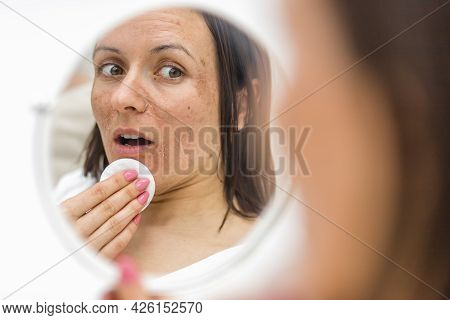 Photo Of Woman Having Skin Problems Looking In The Mirror.