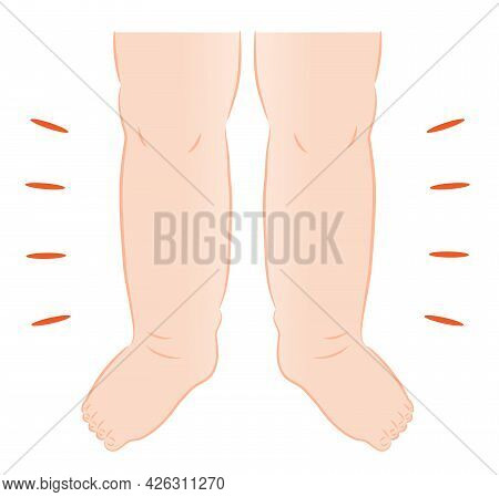 Swollen Feet Illustration. Health And Beauty Care Concept.