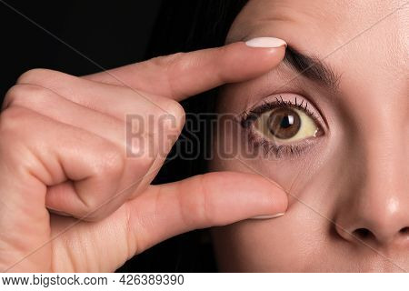 Woman Checking Her Health Condition On Black Background, Closeup. Yellow Eyes As Symptom Of Problems