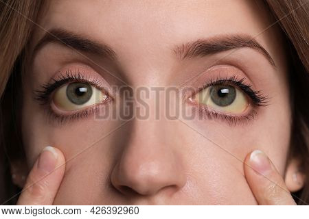 Woman Checking Her Health Condition, Closeup. Yellow Eyes As Symptom Of Problems With Liver