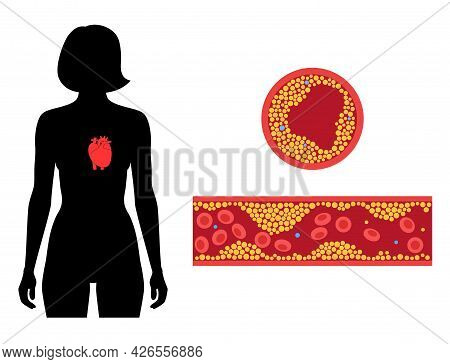 Cholesterol In Human Blood Vessels. Heart Logo In Woman Silhouette. Fat Cells In Vein. High Ldl And 