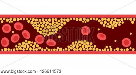 Arteriosclerosis, Infarct, Ischemia, Thrombosis Disease. Cholesterol In Human Blood Vessels. High Ld