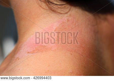 Dangerous Consequences Of A Sunburn On Shoulders Of A Young Girl, Reddened Skin With Damaged Skin Ar