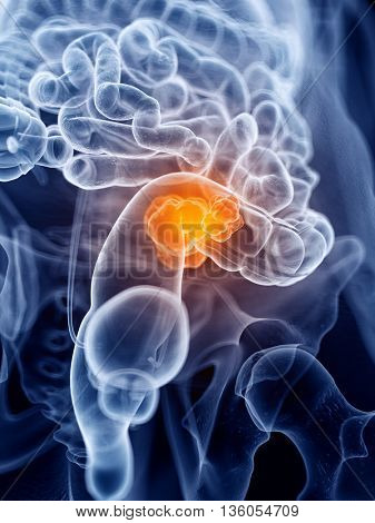 3d rendered, medically accurate illustration of colorectal cancer
