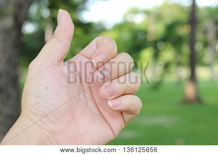 Finger With Onychomycosis. A Toenail Fungus.. - Soft Focus