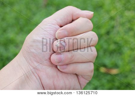 Finger With Onychomycosis. A Toenail Fungus.. - Soft Focus
