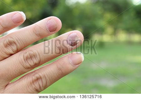 Finger With Onychomycosis. A Toenail Fungus.. - Soft Focus