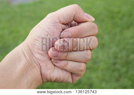 Finger With Onychomycosis. A Toenail Fungus.. - Soft Focus