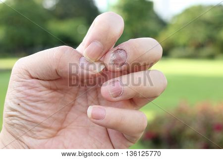 Finger With Onychomycosis. A Toenail Fungus.. - Soft Focus