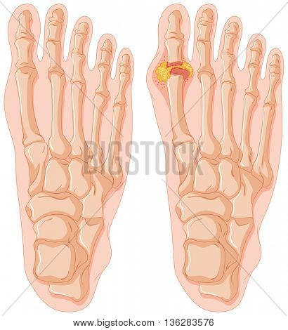 Diagram of gout in human toe illustration
