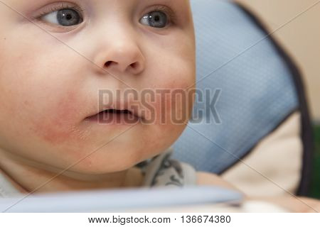 Photo of baby with red cheek - diathesis