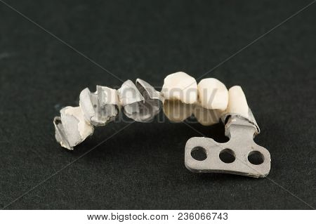 Damaged Dental Cermet Bridge Prosthesis On A Lamellar Implant
