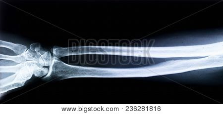 X-ray Of Human Arm. X-ray Image Concept.