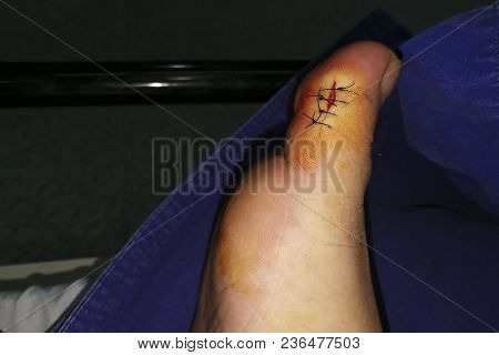 Cut Wound At Right Toe, 4 Stitches Sewn With Black Thread. Wound Caused By Broken Glass. Suturated W