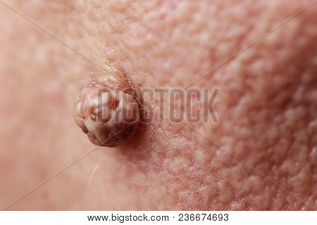 Details Of Senior Woman Face. Elderly Pensioner Female, Dermal Fibroma Close Up.