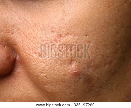 Inflamed Skin On The Face. Acne. Pimples On The Skin. Scars And Peeling.