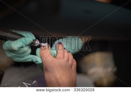 Podiatrist Treating Toenail. Podology Treatment. Podology Of Applying Gel Polish To Remove Onycholys