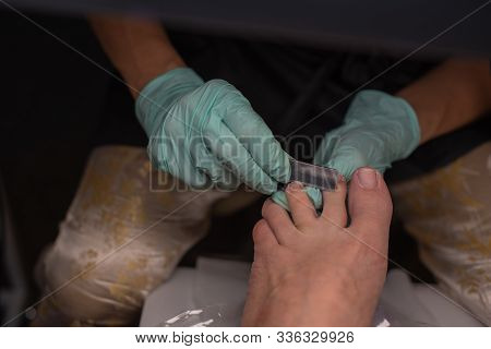 Podiatrist Treating Toenail. Podology Treatment. Podology Of Applying Gel Polish To Remove Onycholys